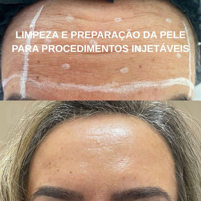 Limpeza de pele profissional em Guarulhos