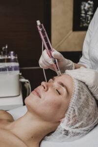 Microagulhamento facial clínica de estética silvana araújo Guarulhos