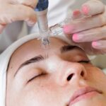 microagulhamento estetica silvana araujo guarulhos