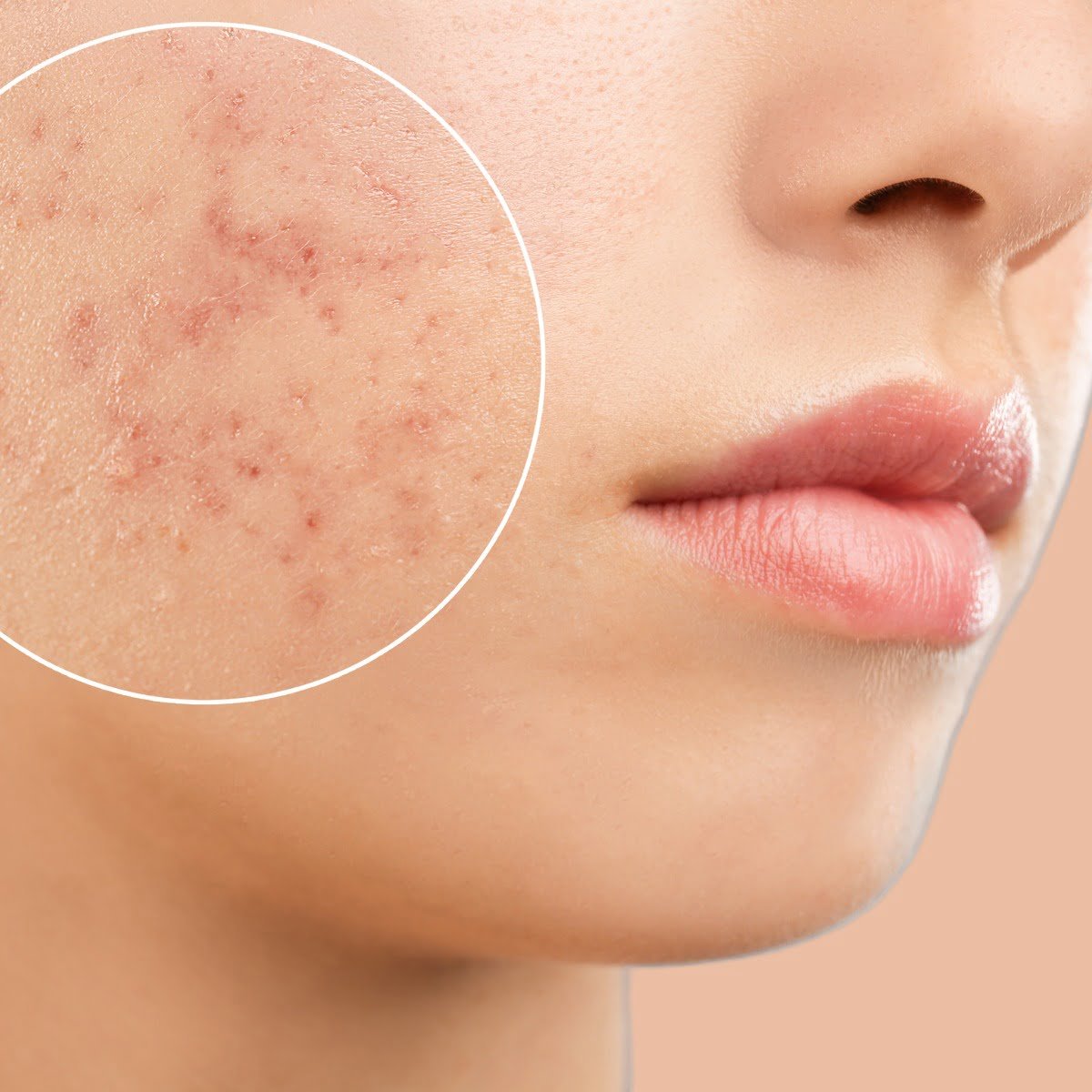 Cicatrizes de acne | Clínica de estética no Centro de Guarulhos