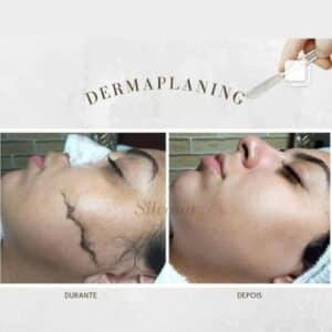 Dúvidas sobre Dermaplaning Guarulhos