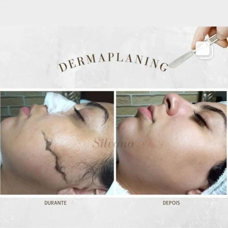 Dúvidas sobre Dermaplaning