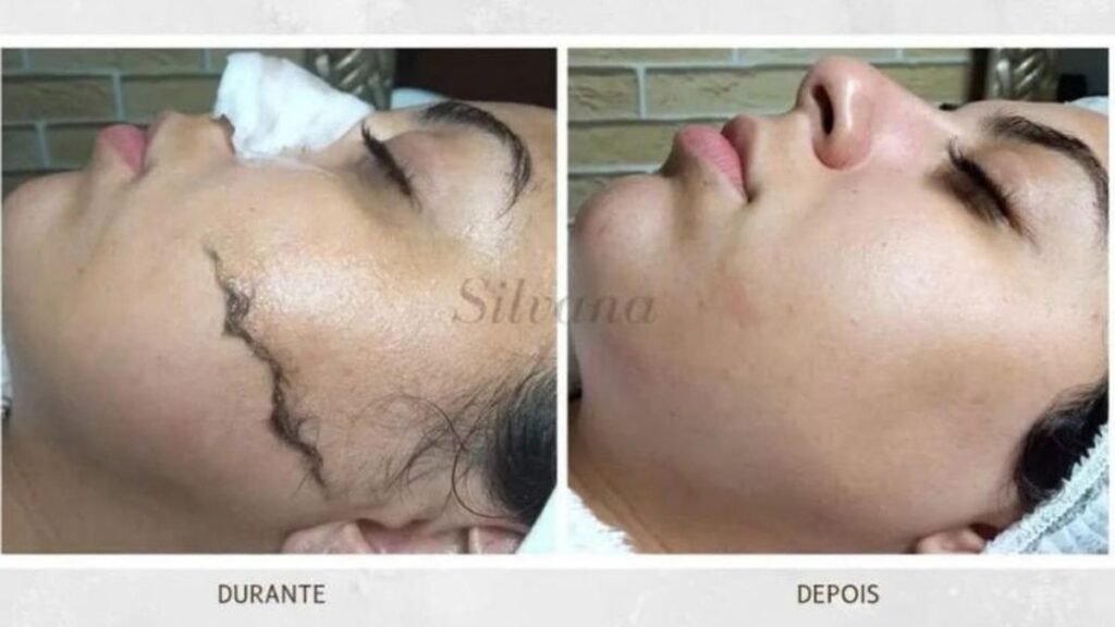 Dúvidas sobre Dermaplaning Guarulhos